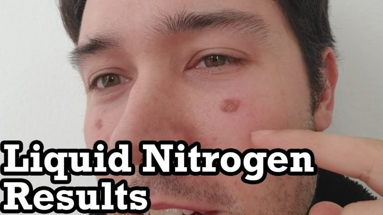 Post-Liquid Nitrogen Treatment Skincare: What to Apply