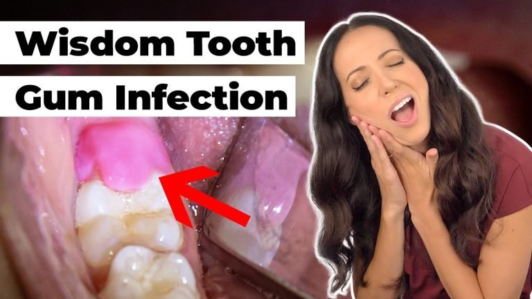 Swollen Gum Behind Back Tooth: Reddit's Wisdom Teeth-Free Solutions