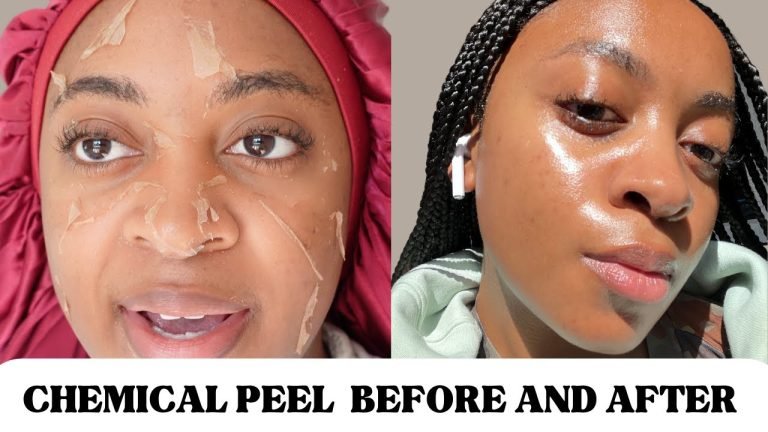 Before and After: African American Chemical Peel for Black Skin