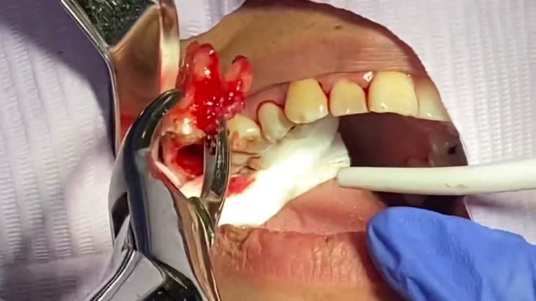DIY Tooth Extraction: Removing a Broken Tooth at the Gum Line